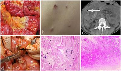 Degos disease with multiple intestinal perforations: A missed-opportunity case report and literature review